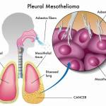 Pleural_mesothelioma Profile Picture