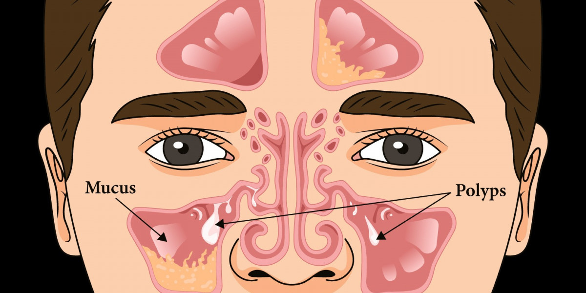 Nasal Polyps Market 2024: Latest Trends, Share, Industry Size, Growth Analysis, & Forecast Report by 2034